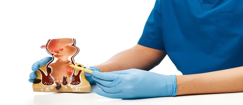 Best Fissure & Fistula Treatment in Sakinaka,Andheri